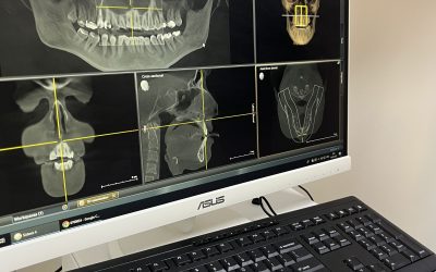 Компʼютерна томографія зубів: 3D панорамний знімок щелепи в Кременчуці